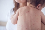 measles rash, measles pictures, measles back in the united states as children omit vaccination doses, Toddler