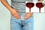 Bladder Cancer in men, Bladder Cancer treatment, why is bladder cancer common in men, Cigarette