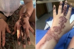 henna burns treatment, henna tattoo side effects, henna tattoo cause aussie woman to almost lose her hand, Tattoos