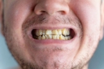 Nicotine stains teeth, Nicotine stains research, are nicotine stains on your teeth irreversible, Tobacco